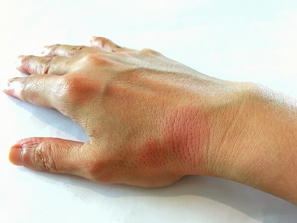 ביטוח לחולים בלופוס